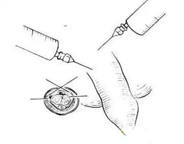 小儿包皮手术图解