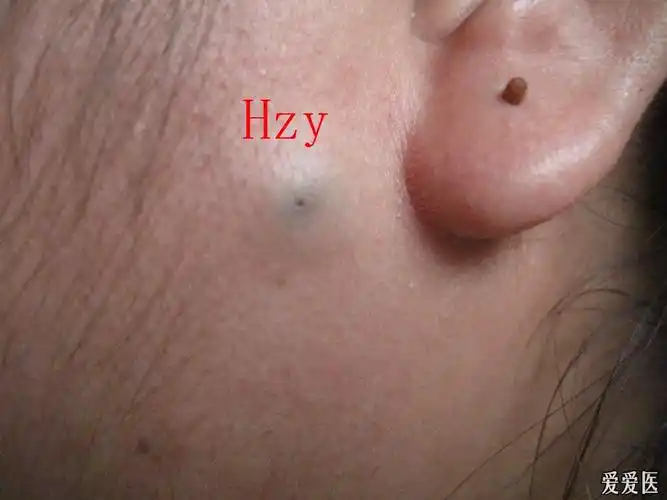 看图诊病皮脂腺囊肿粉瘤