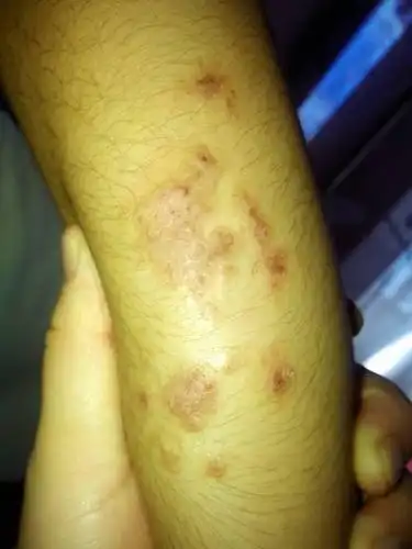 问:有谁知道是什么样的皮肤病么?