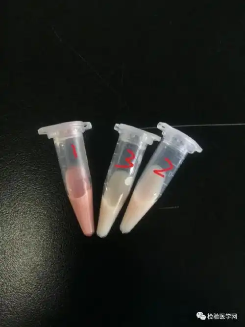 血红蛋白异常增高竟是