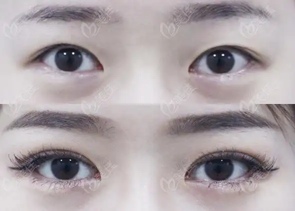 韩国可来熙双眼皮前后对比照