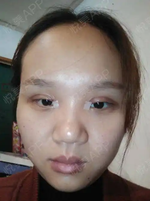 双眼皮割完有一个月了 左眼有点提肌无力怎么办_悦美整形