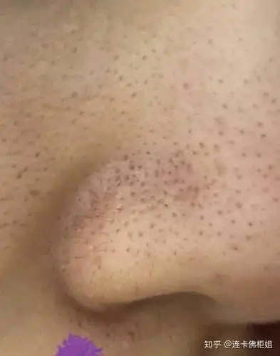 你这鼻子有好几个问题, 黑头,毛孔粗大,黑毛(毳毛或者小刺毛),黑色素