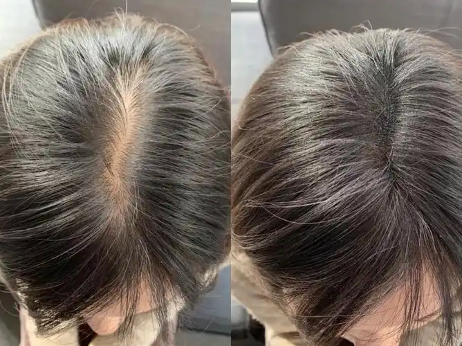 吃什么生发效果好_有助于生发的食物_生发帽|红蓝光治疗仪|光子嫩肤仪