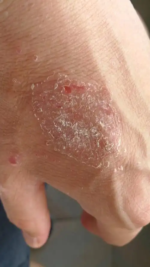 我的湿疹为什么这样难治?