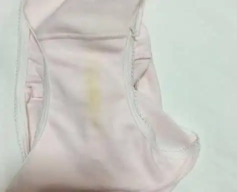 女性宫颈癌缠身内裤会有3印记若全占子宫百孔千疮