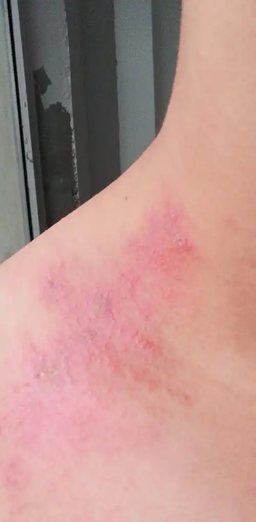 我被蜘蛛咬了怎么办