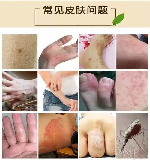 苗先锋去除治顽固慢性湿疹阴囊潮湿真菌男女外阴部私处皮肤瘙痒大腿