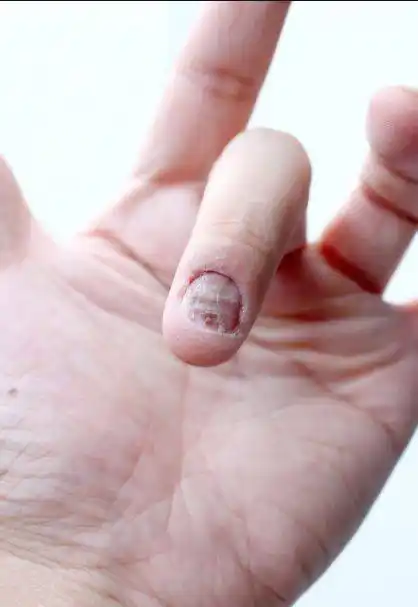 经常咬指甲对指甲肯定是有伤害的,在咬指甲的时候,会让指甲变得很丑