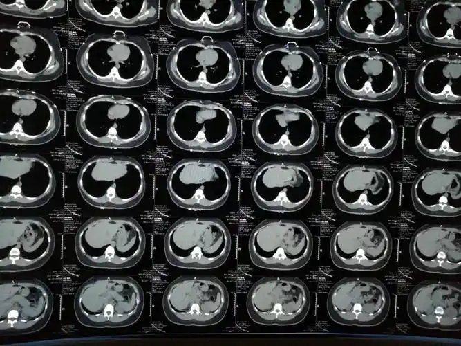 人的胸部ct结果,医生会在报告单中写平扫肺窗(肺窗主要显示肺部组织