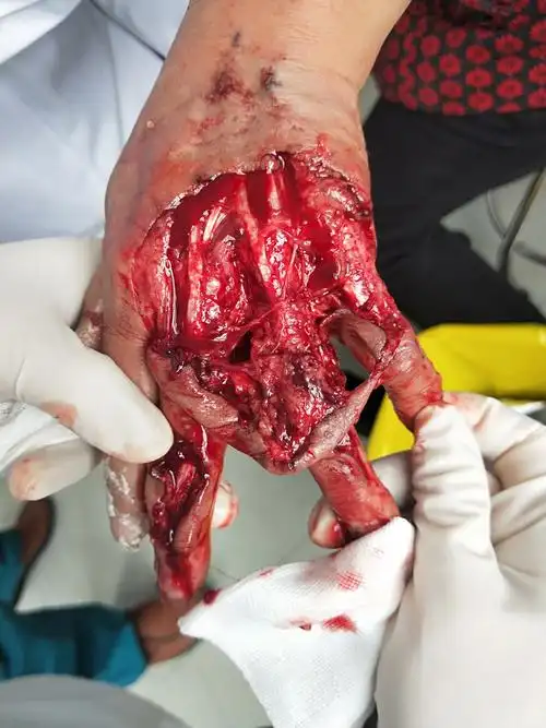 手外创伤伤类病人