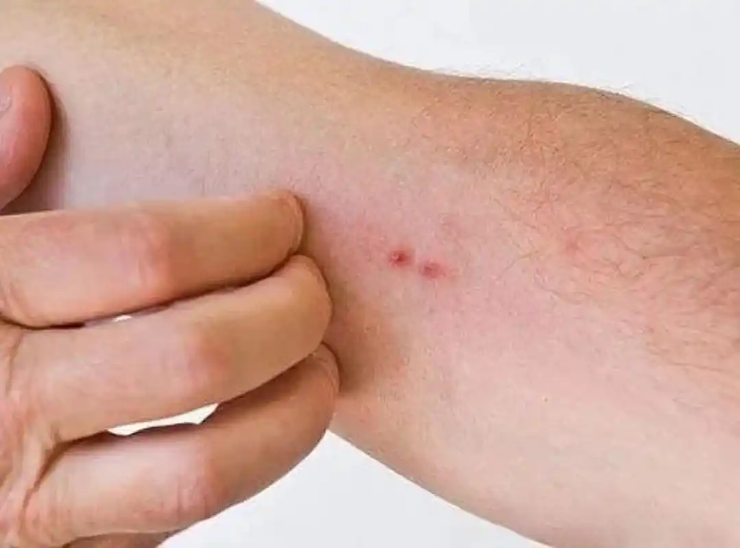 常见的3类螨虫危害及除螨方法 随尘飞扬的尘螨 尘螨,是居室内最常见的