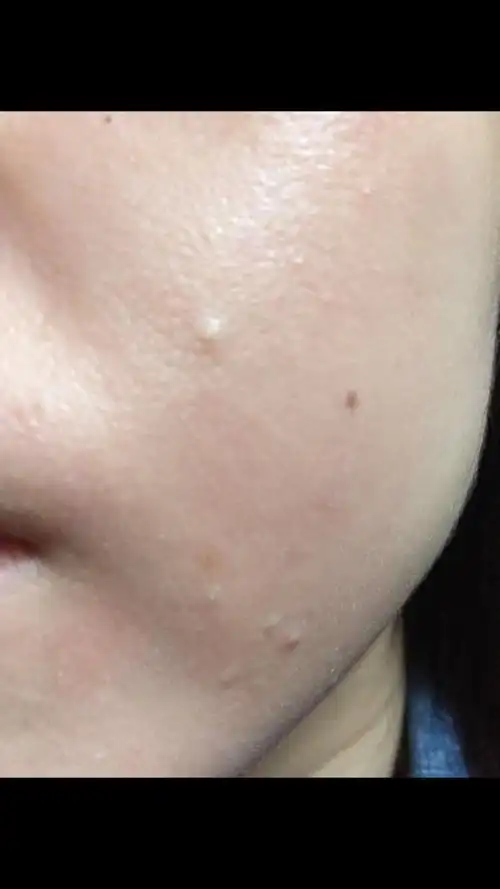 左脸颊和额头都有长这个,是闭合性粉刺吗?怎么处理?