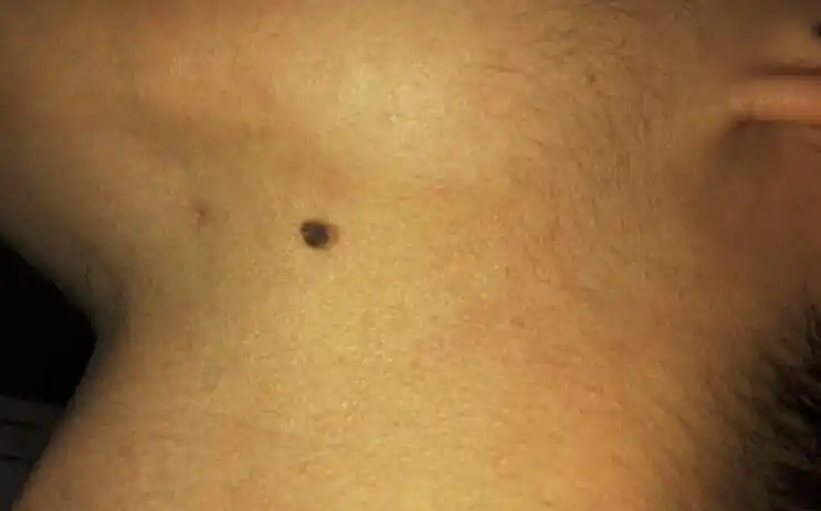 下巴的黑痣,破溃结痂后又重生长.大概持续4,5年,请问是否癌