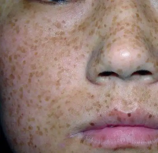 芝麻饼脸可能是黑色素疯狂繁殖色斑试试古时1种淡斑粉