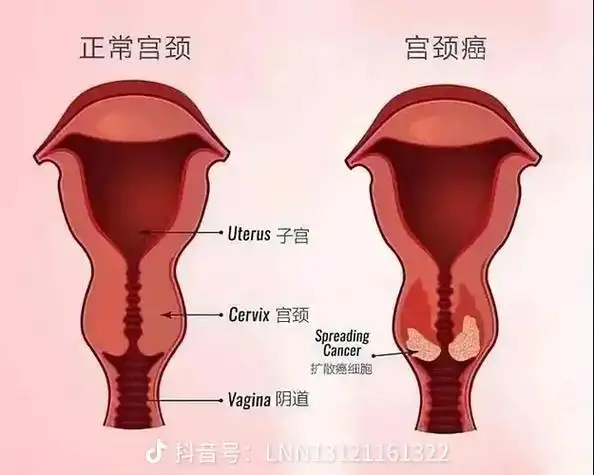 宫颈癌示意图 - 抖音