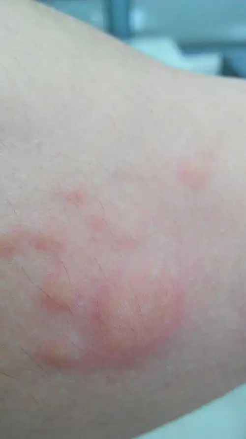 现在关节处,红块时多时少,有几次过敏十分严重,全身都是红块连成片.