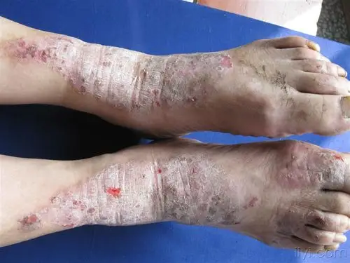 看图识病神经性皮炎