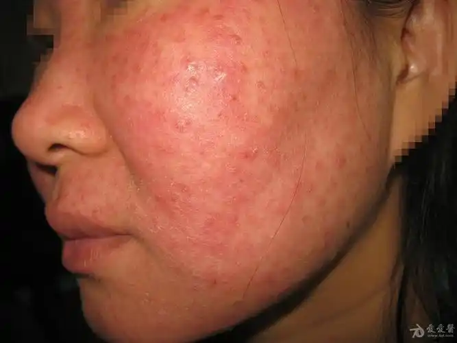所见最严重的面部蠕型螨皮炎1例 - 皮肤及性传播疾病讨论版 - 爱爱医