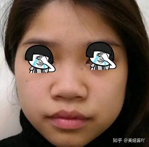 拥有宽鼻翼大鼻头是怎样一种体验? - 知乎