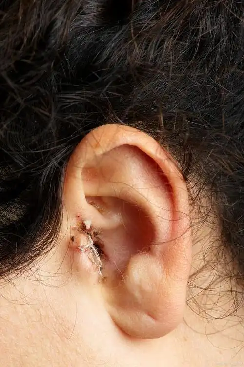 耳廓软骨膜炎早期症状有哪些?如何治疗?