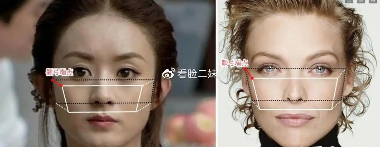 图解对比,让你三分钟知道颧骨高和颧骨外扩的区别是什么?