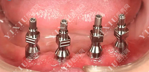 下半口种四颗种植牙的图片