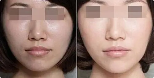 美白注射前后对比图美白注射效果图美白注射前后对比照片