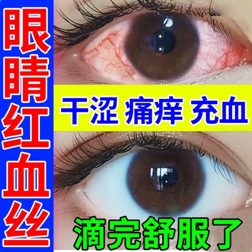 眼睛红血丝眼药水滴眼液眼部疲劳结膜充血视力模糊眼睛酸胀干涩痛痒