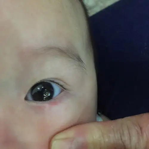 宝宝四个月,下班回家发现宝宝眼皮有块红,请问这是什么?