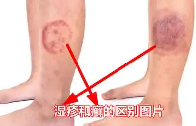 湿疹和癣的区别图片(区分图对比)