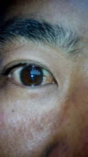 你好我眼球上起了一个小疙瘩怎么回事开始