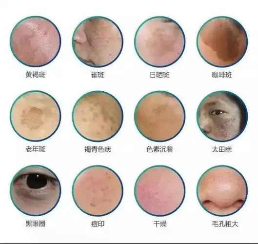 冬季紫外线较弱是祛斑的黄金时期