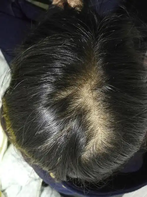 常年熬夜 发量不少 不掉发但头顶秃的我本人