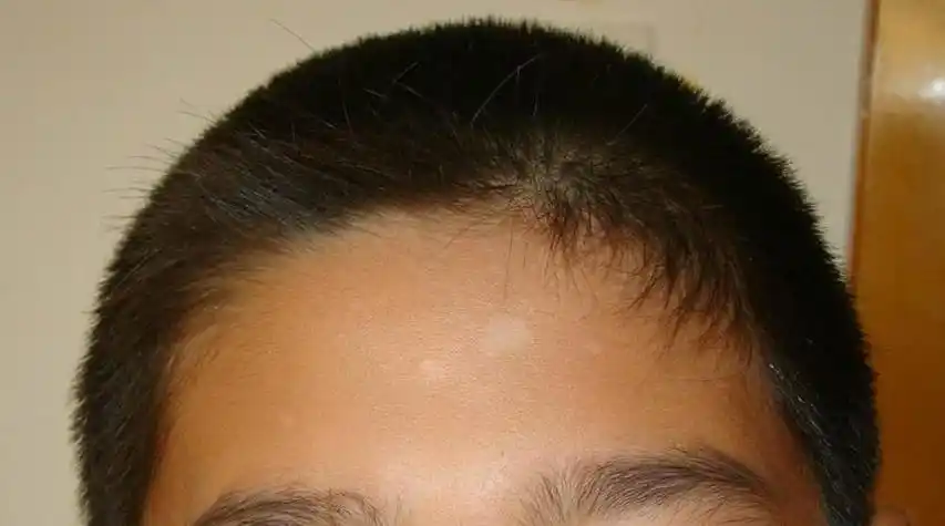 白癜风初期能治好吗?