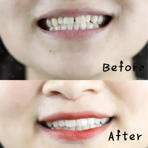 矫正器不好好戴就会像我一样 牙齿反弹