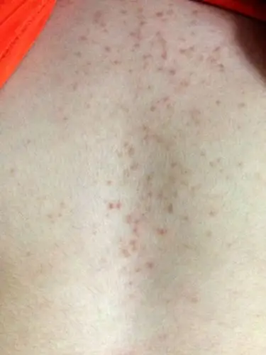 阴茎长毛囊炎的症状图片