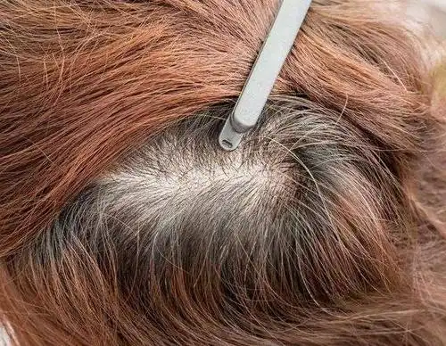 头皮发根疼是怎么回事 头皮头发根疼是怎么回事- 育儿指南