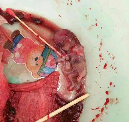 宝宝四个月大了又怀孕了能药流吗?安全吗?只看楼主