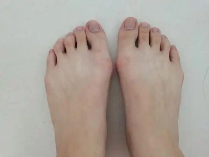 拇外翻矫正带为何不能有效矫正大脚骨?别被收了智商税