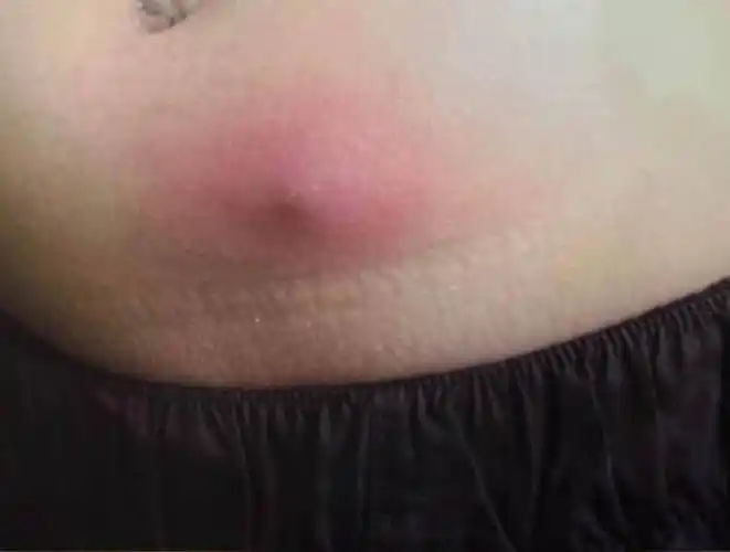 前胸后背,头皮,私处反复长红疙瘩,小心是毛囊炎作祟_医生_治疗_症状