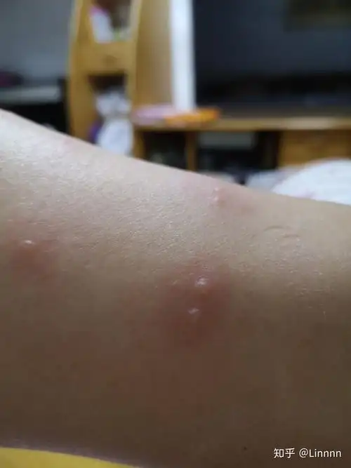 被跳蚤咬的全身都是包是什么样的感受