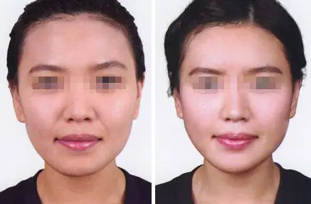 吃什么可以有助消除法令纹