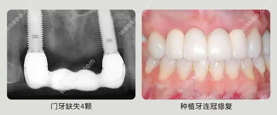 在珠海做一颗种植牙要多少钱?进口和国产种牙价格表公开啦