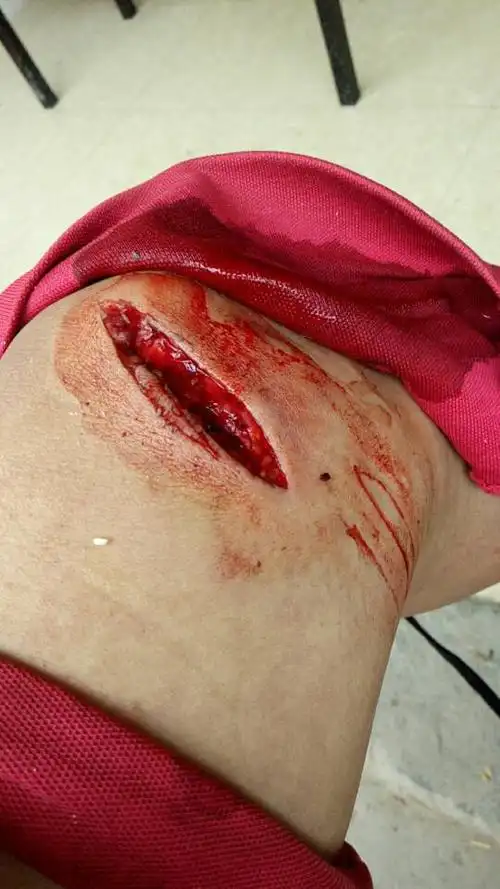 我在广西武宣砍桉树,脚被油锯锯伤,老板工资没付,医药费付一小部分