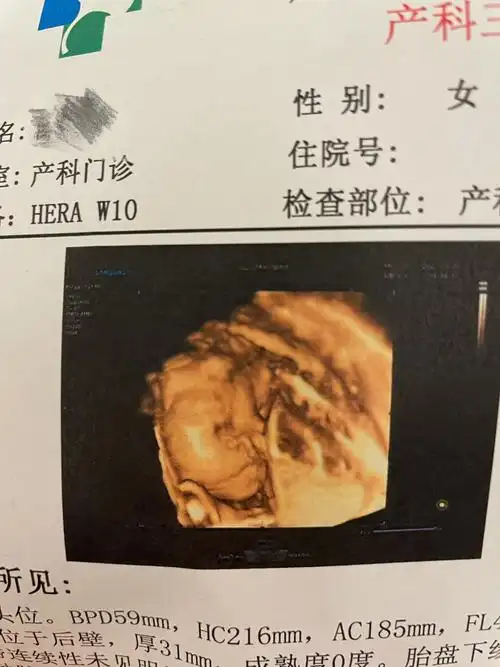 照了五次的四维照,害羞的宝宝,始终不肯漏整张脸,只能照了一张被脐带