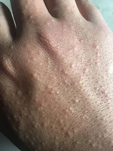 手背莫名其妙起了些疹子,什么情况呢?