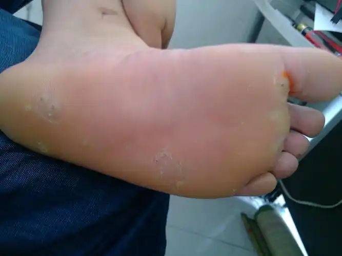 我的脚底长了9个小包,不知道是鸡眼还是肉刺,我想咨询一下,这个到底是