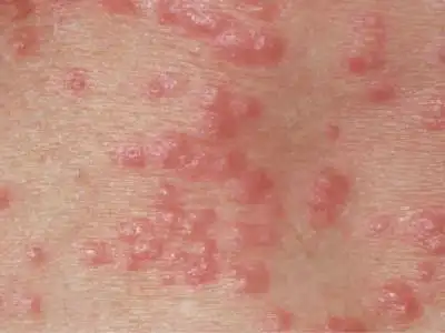 学生疥疮是怎么引起的