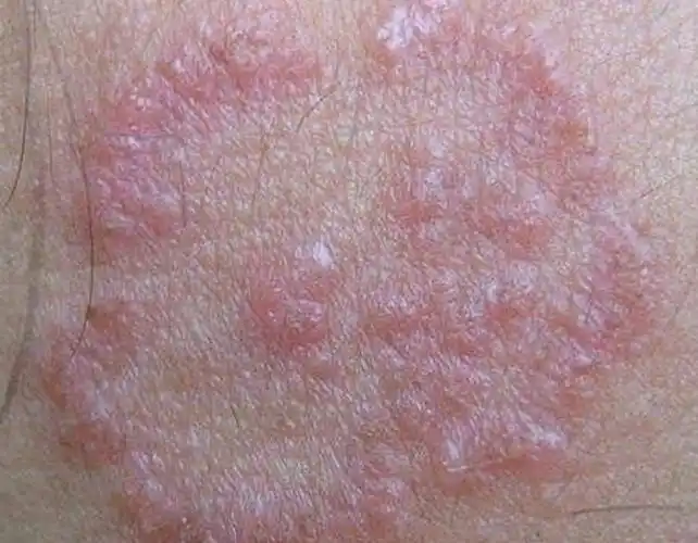 女性股藓症状表现的图片_有来医生